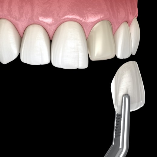 Animated smile during porcelain veneer cosmetic dentistry treatment