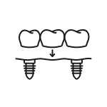 Animated dental implant supported fixed bridge placement