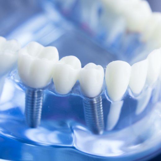 Model smile with dental bridge replacing missing teeth