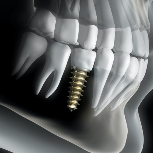 Animated smile with dental implant supported dental crown